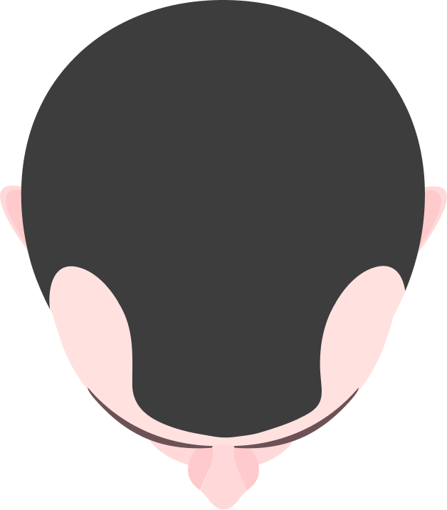 Receding hairline